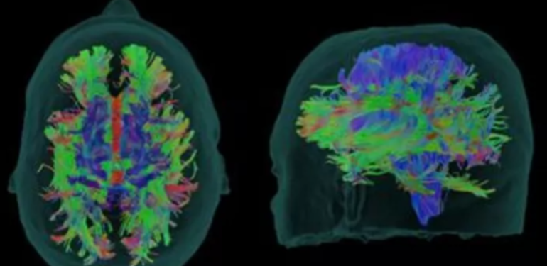 Yeni formül: Alzheimer’ın ilerlemesini üçte bir yavaşlatıyor